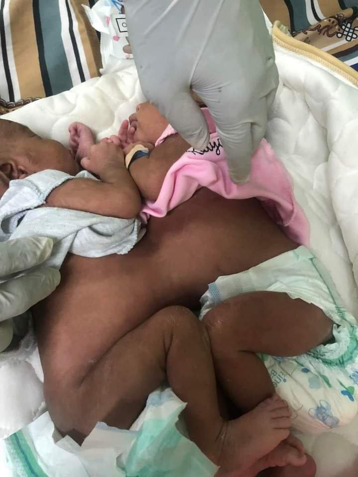 وردنا الان| إجراء أول عملية جراحية لفصل توائم سياميين بالسودان 15 IMG 20220731 WA0060