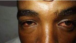 طوارئ شرق النيل :انتشار ٱلتهاب ملتحمة العين 12 طوارئ شرق النيل :انتشار ٱلتهاب ملتحمة العين