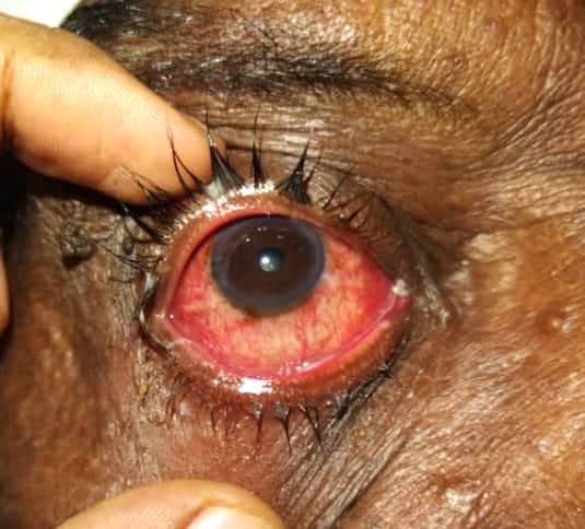 طوارئ شرق النيل :انتشار ٱلتهاب ملتحمة العين 11 ٢١ ٤٢ ٤١ IMG 20240810 WA0090 1