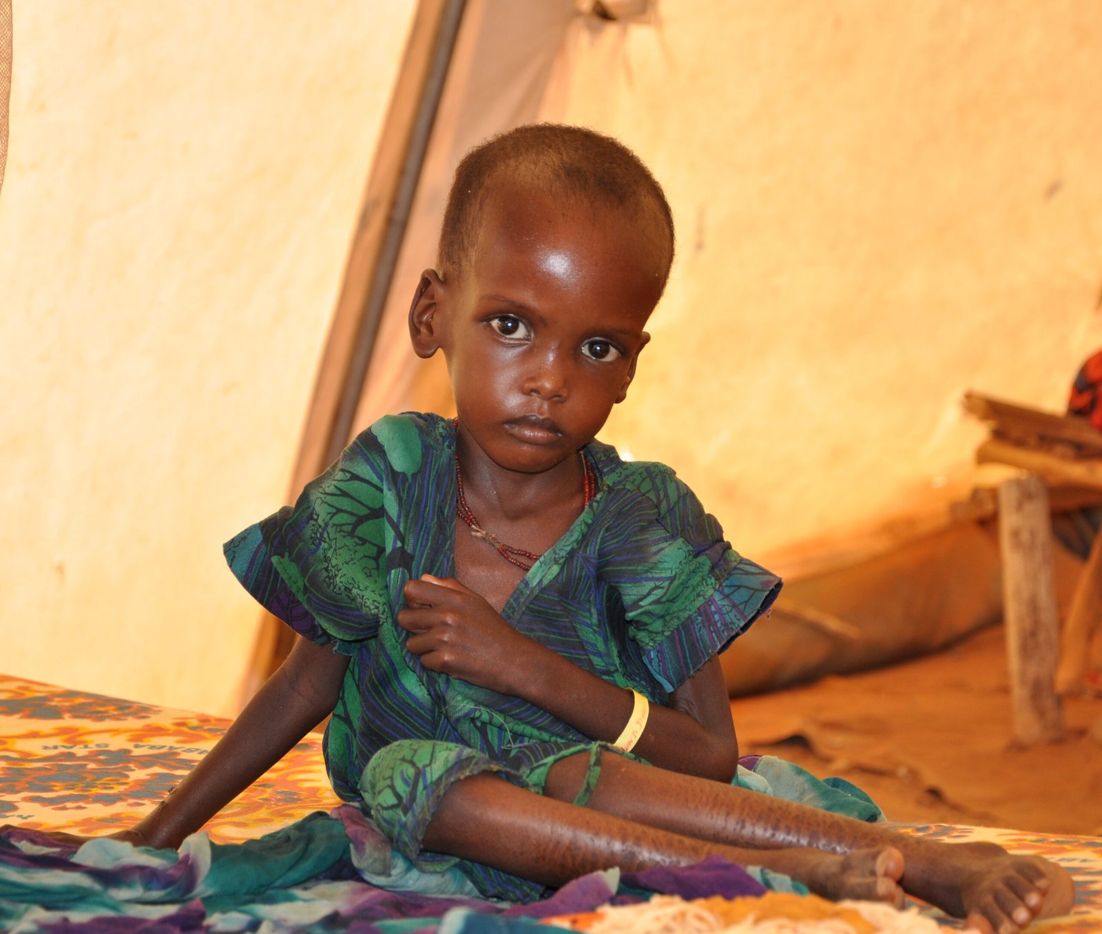 A malnourished child in an MSF treatment tent in Dolo Ado scaled